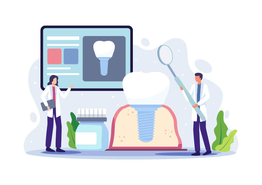 Warum Zahnimplantate sich unterscheiden